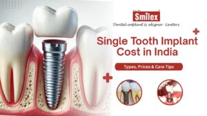 Dental Implant
