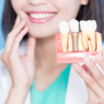 Same-Day Dental Implants in Pune