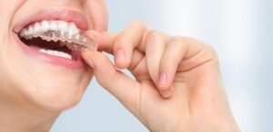 Clear Aligners in Pune