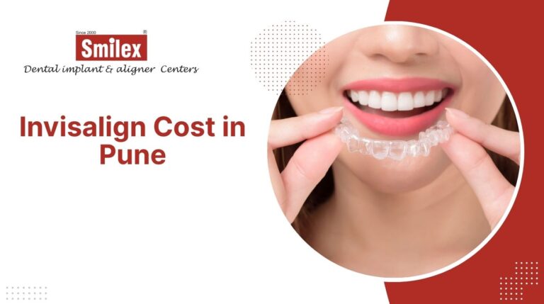 Invisalign Aligner in Pune