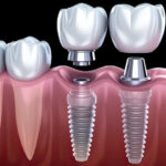 Best Dental Implants in Pune