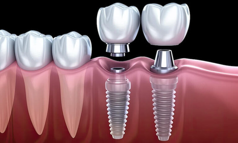 Best Dental Implants in Pune