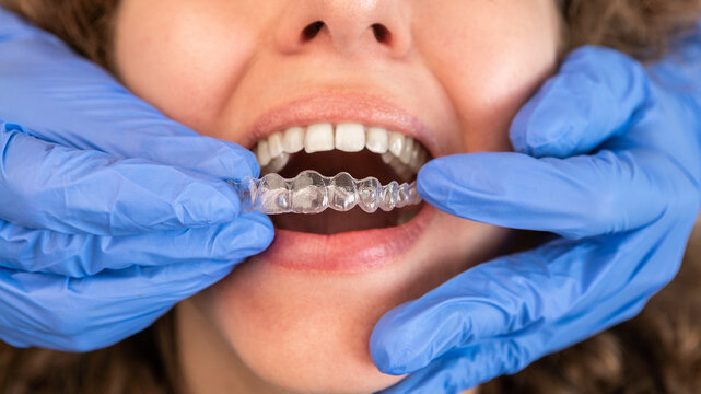 Invisible Braces Pune | Get a Confident Smile with Advanced Invisalign Treatment