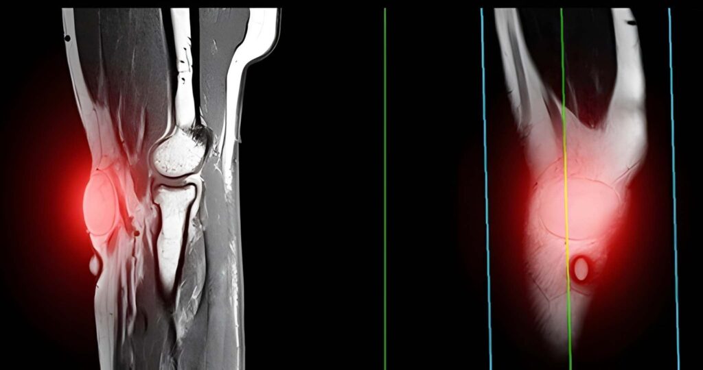 Are You Ignoring Signs That May Require Lipoma Removal Soon