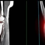 Are You Ignoring Signs That May Require Lipoma Removal Soon