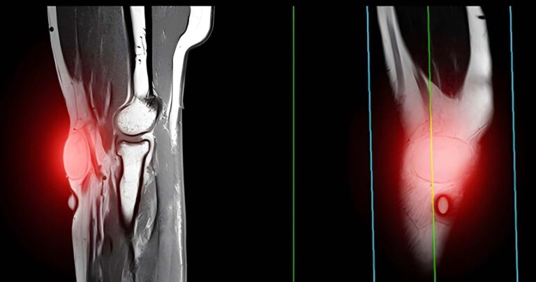 Are You Ignoring Signs That May Require Lipoma Removal Soon