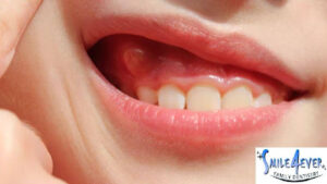 Augmentin for a Tooth Infection