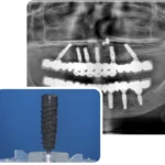 dental-implant-about.webp.bv