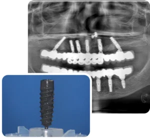 dental-implant-about.webp.bv