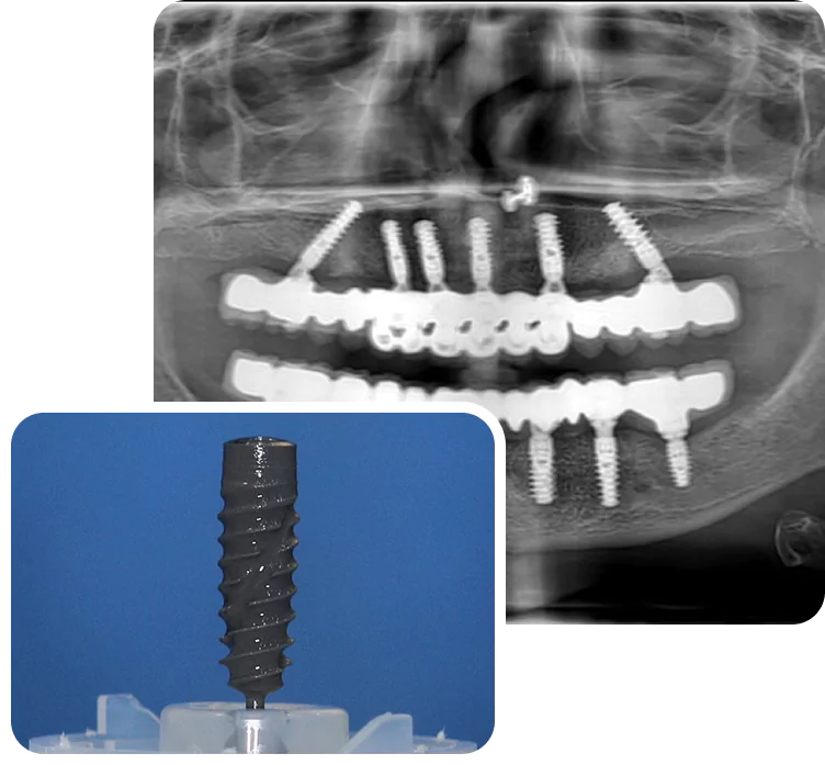 dental-implant-about.webp.bv