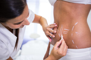surgeon-drawing-lines-womans-abdomen-liposuction-cellulite-removal-300x200.jpg