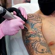Best Tattoo Removal Doctor In India