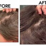 Hair specialist examining scalp and providing advanced hair restoration treatment for healthier hair growth in India