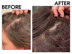 Hair specialist examining scalp and providing advanced hair restoration treatment for healthier hair growth in India