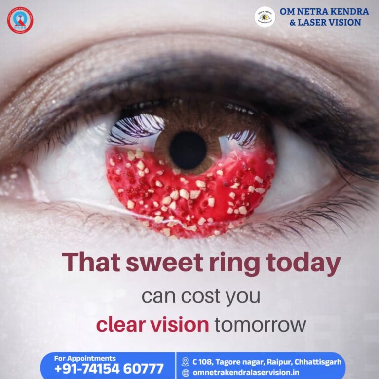 Best Squint Surgery in Raipur