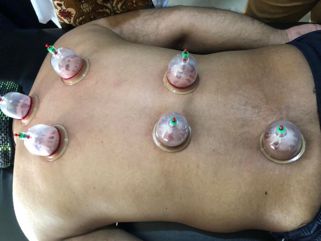 cost of cupping in Pakistan