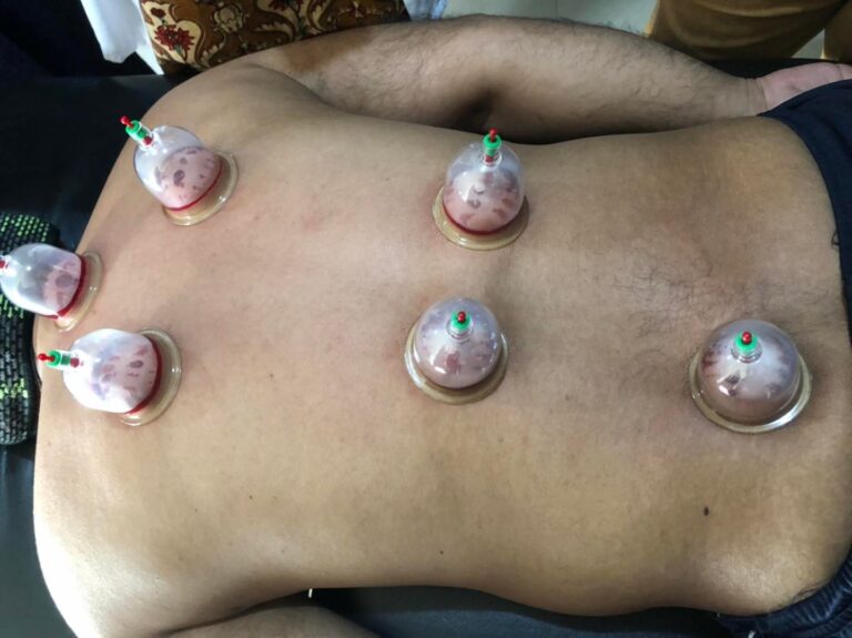 cost of cupping in Pakistan
