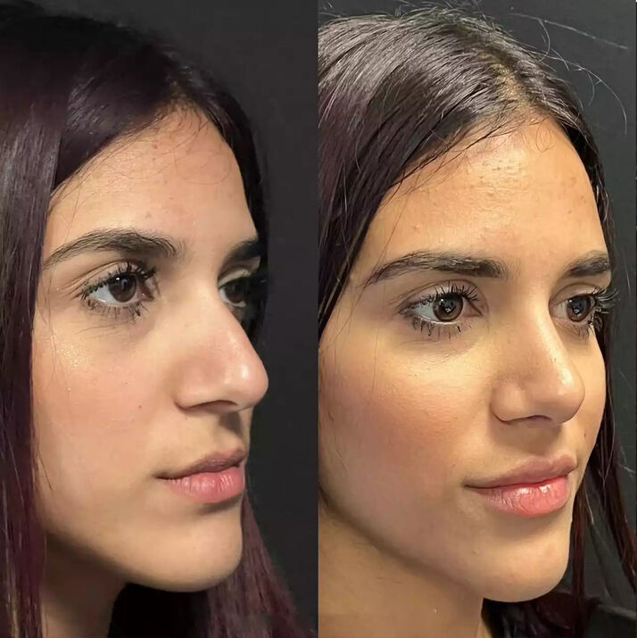 Septoplasty in Dubai