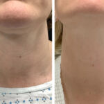 Radiofrequency (RF) Microneedling treatments in Dubai with Modern Laser Technology