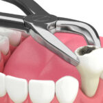 3d render of lower jaw with tooth extracted by dental forceps