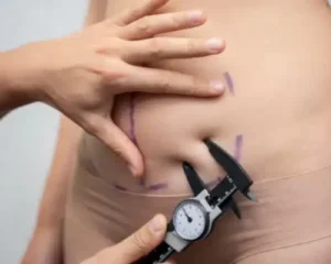 tummy tuck in lahore