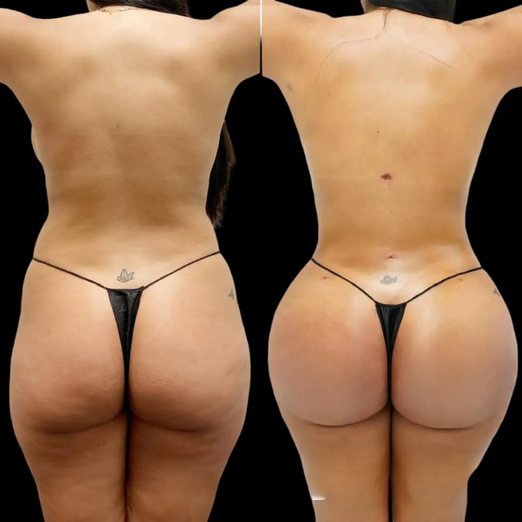 fat transfer in dubai