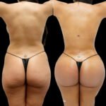 fat transfer in dubai