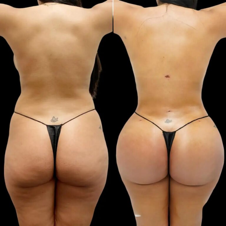 fat transfer in dubai