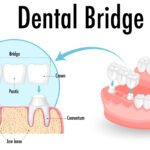 Dental bridge in hudson