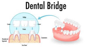 Dental bridge in hudson