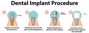 Dental implant