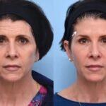 Botox in dubai