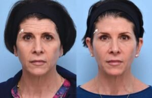 Botox in dubai