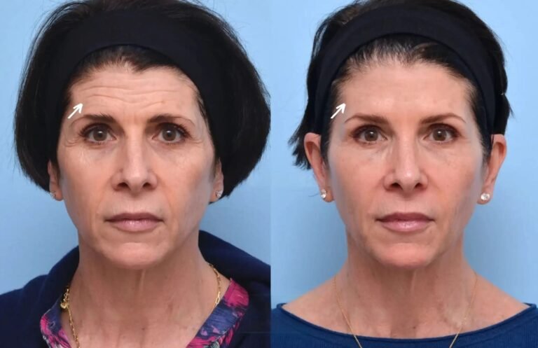 Botox in dubai