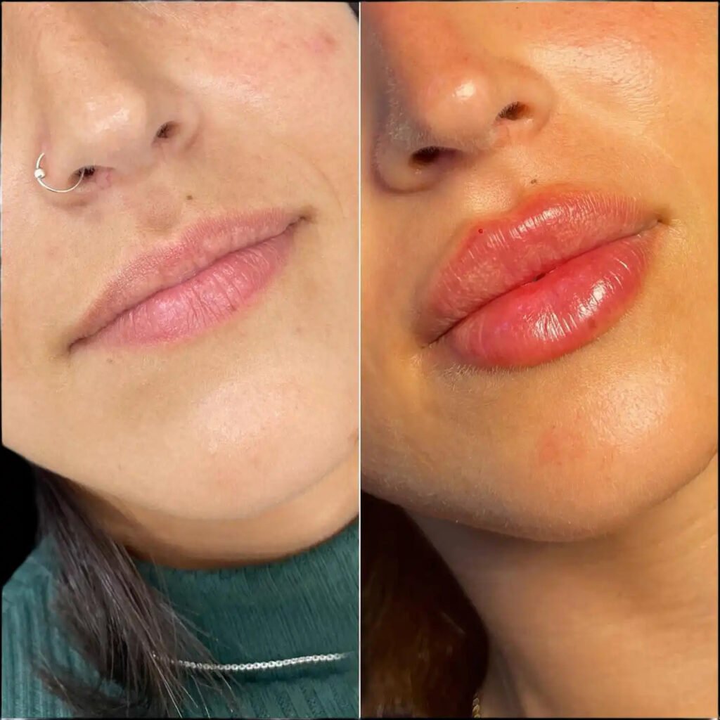 fillers