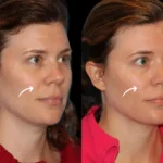 sculptra in dubai