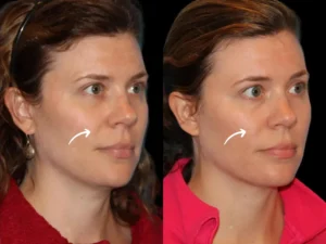 sculptra in dubai