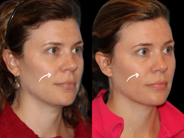 sculptra in dubai