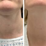 Best Aesthetic Clinic in dubai for Radiofrequency Microneedling Skin Repair