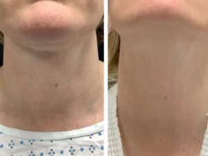 Best Aesthetic Clinic in dubai for Radiofrequency Microneedling Skin Repair