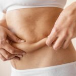 Liposuction in Dubai