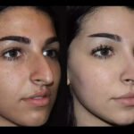 Septoplasty in Dubai