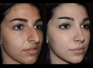 Septoplasty in Dubai