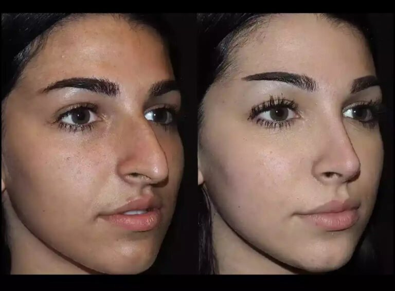 Septoplasty in Dubai