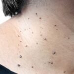Skin-Tag-Removal-