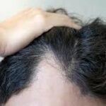 Stem Cell Therapy for Hair in Dubai
