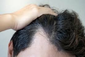 Stem Cell Therapy for Hair in Dubai