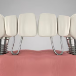 all on 4 dental implants statesville nc