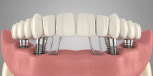 all on 4 dental implants statesville nc