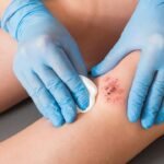 wound care in oakland
